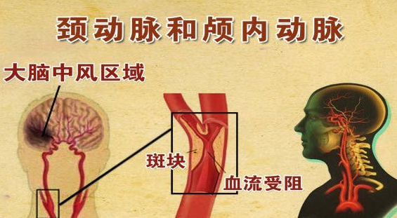 頸部動脈粥樣硬化產生的原因及治療預防新措施