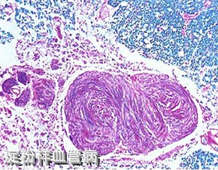 腦淀粉樣血管病中的臨床診治新技術(shù)