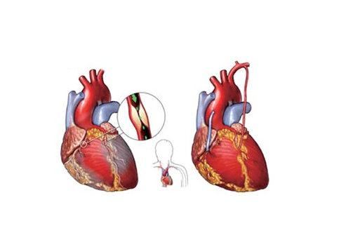 簡析當前急性冠狀動脈的新治療措施